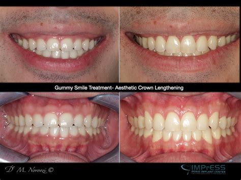 henderson gum surgery